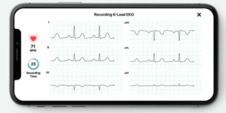 AliveCor-EKG