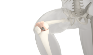 Episurf'knee implant - a diagrammatic image