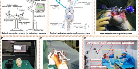 Total knee replacement system