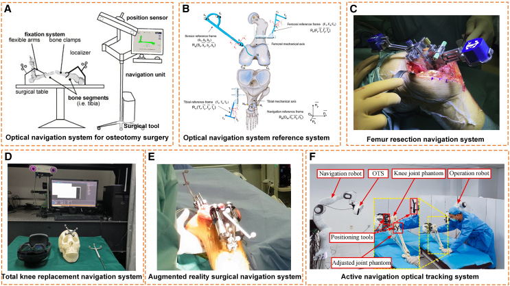 Total knee replacement system